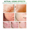 Acne Treatment Serum Facial Repair Oil Breylee