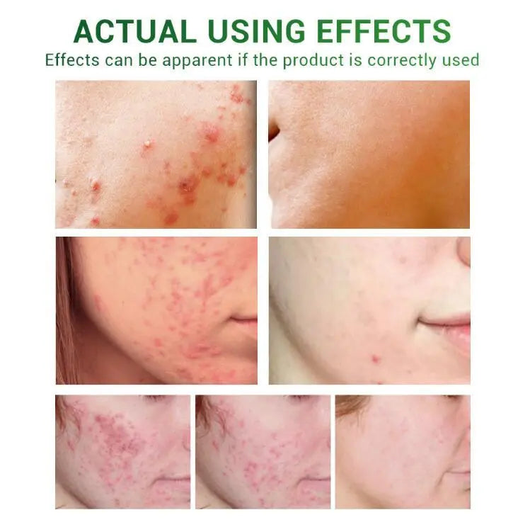Acne Treatment Serum Facial Repair Oil Breylee